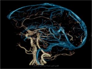 أشعة مقطعية بالصبغة على شرايين المخ
