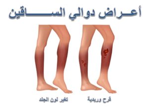 اعراض دوالي الساقين